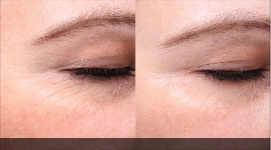Picosecond Laser Machine wrinkle removal