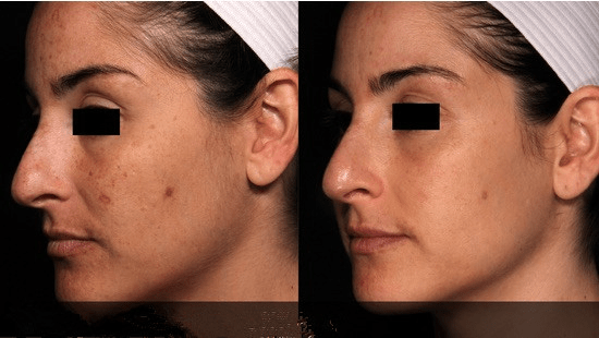 Picosecond Laser acne scar removal
