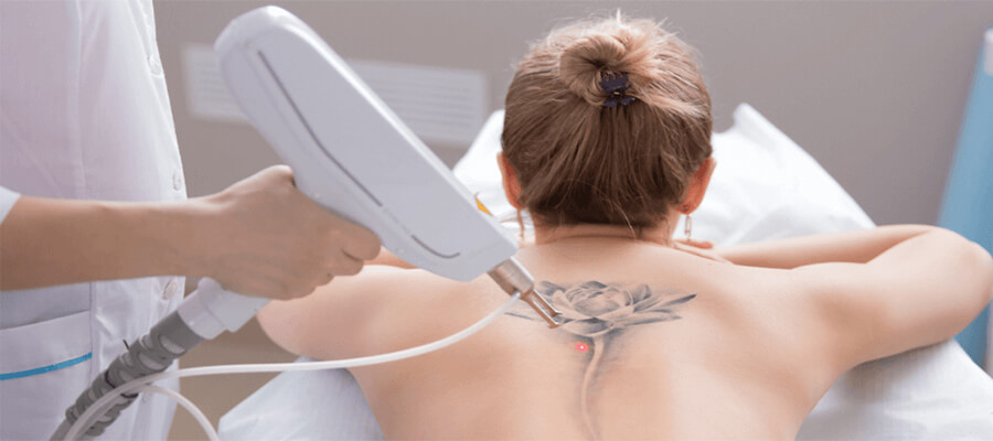 laser tattoo removal side effects