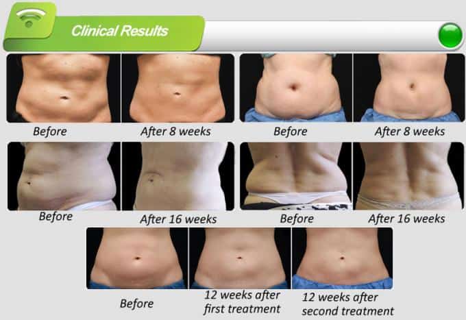 Cryolipolysis