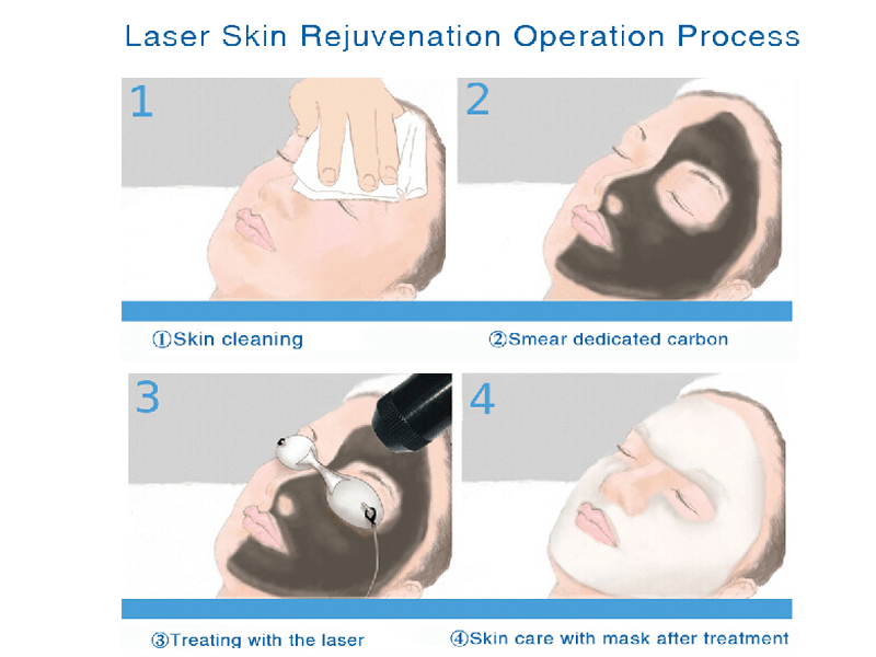 Nd yag laser treatment