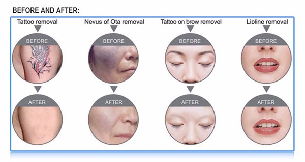 Nd yag laser treatment before and after