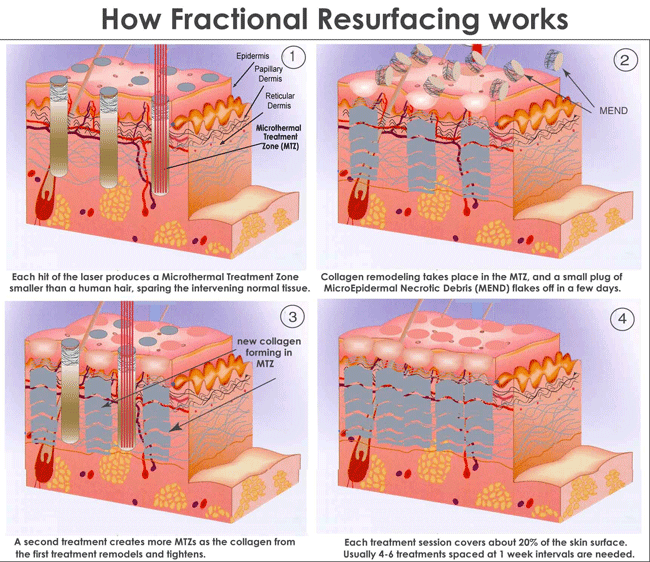 Fractional CO2 laser theory