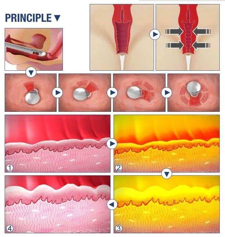 HIFU Vaginal theory