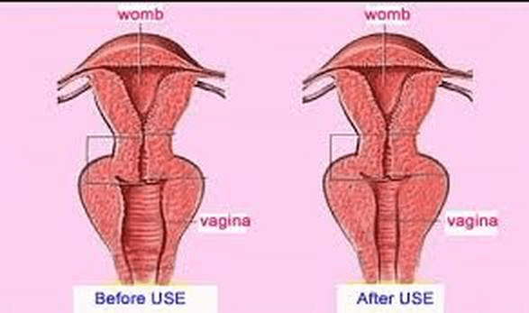 HIFU-Vaginal-treatment