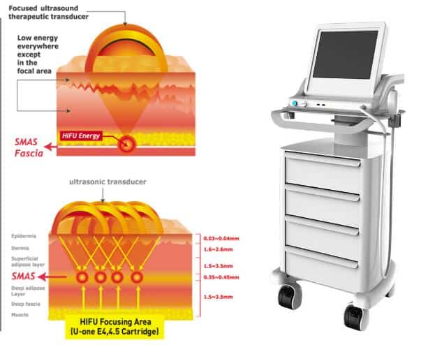 HIFU machine price