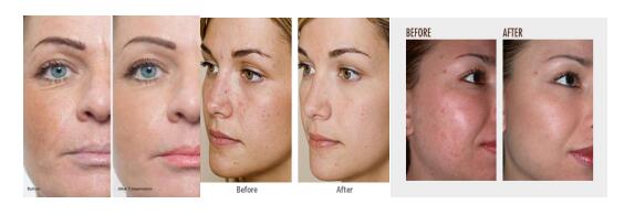 Hydrafacial machine before and after