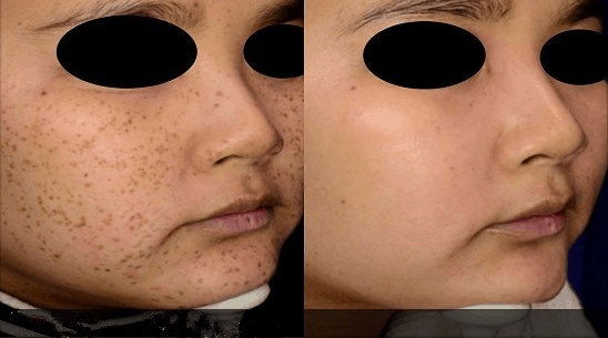 Picosecond Laser Machine sunspot removal