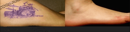 Picosecond Laser tattoo removal