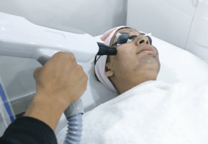 carbon laser facial