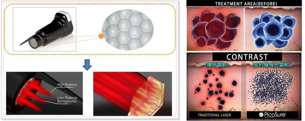 picosure vs traditional laser