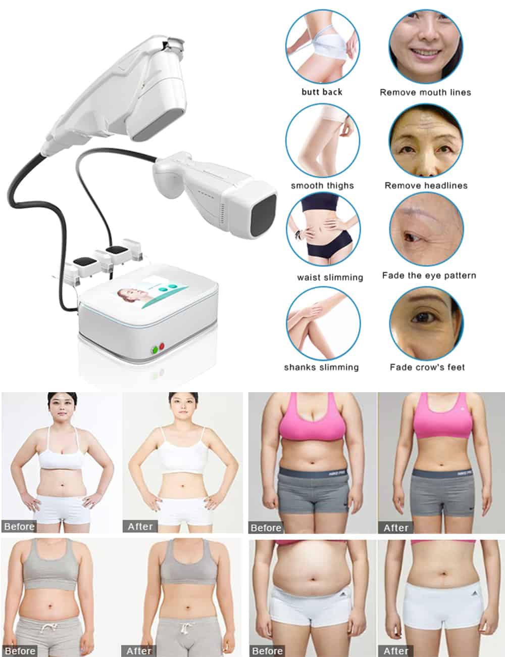 HIFU Liposonix machine Results