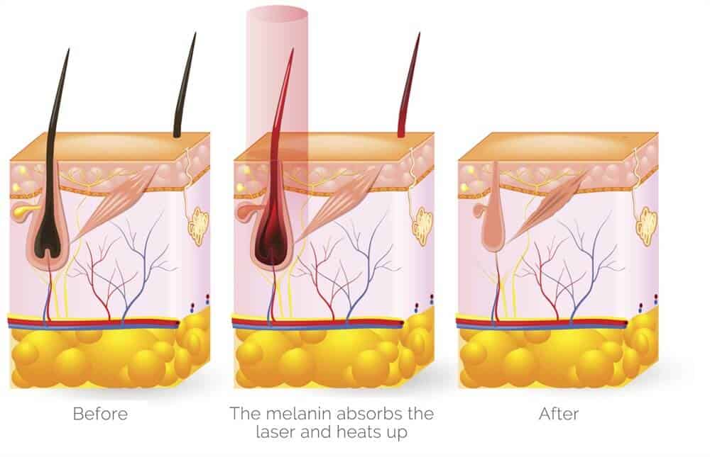 diode laser hair removal machine price