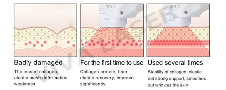 Facail Vaginal HIFU theory