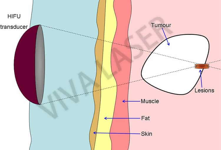 Liposonix machine theory