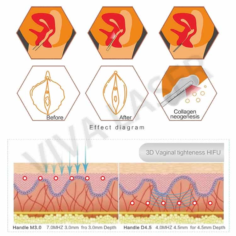 Vaginal HIFU theory