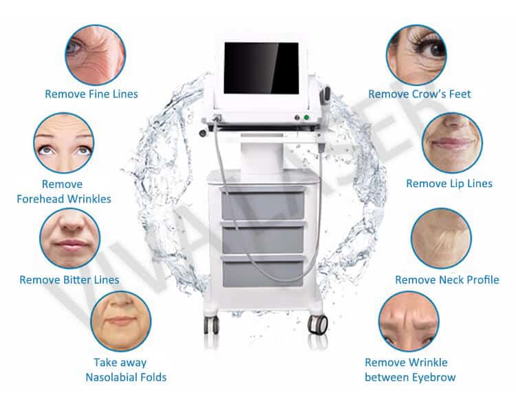 Facial HIFU treatment