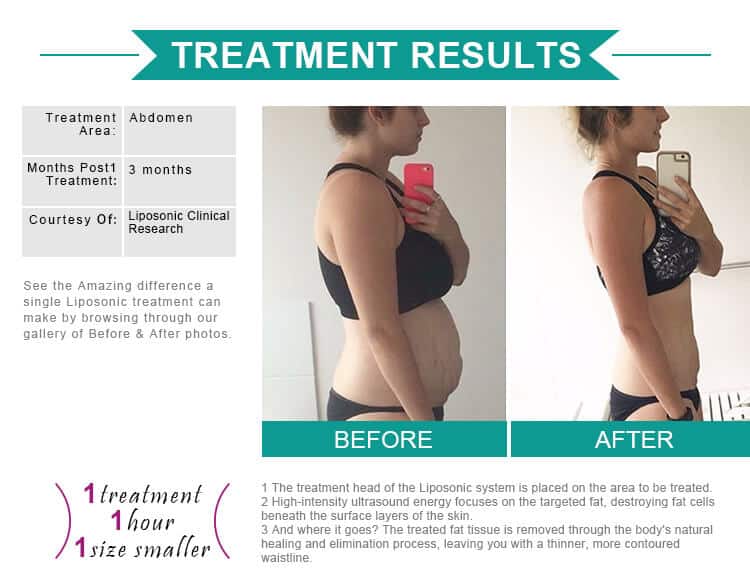 Liposonix machine results