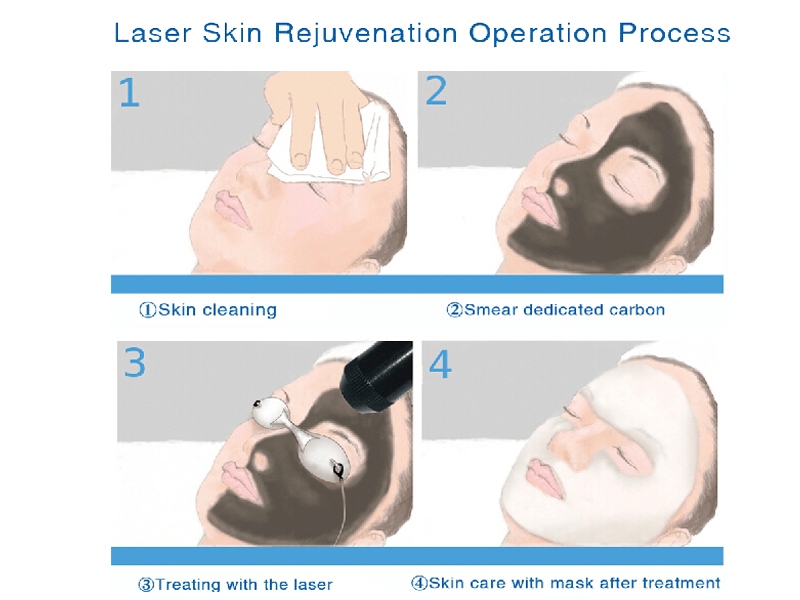 Laser carbon facial treatment procedure