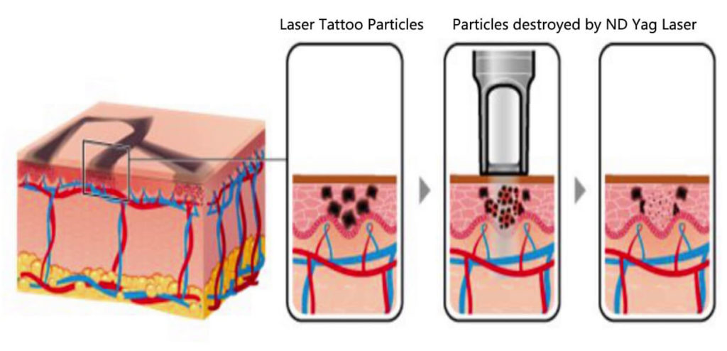 Best laser tattoo removal machine for sale theory