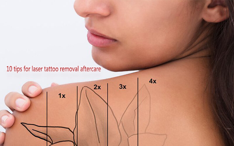 Laser tattoo removal aftercare  Goodbye Tattoos