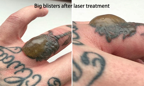 laser tattoo removal blisters